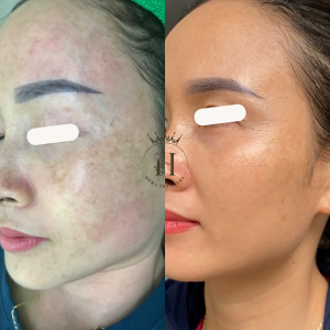 Nám da dạng mảng