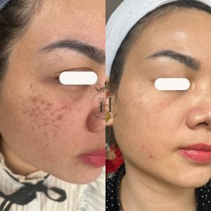 Khách hàng sắc tố bớt Hori, ảnh trước và sau
