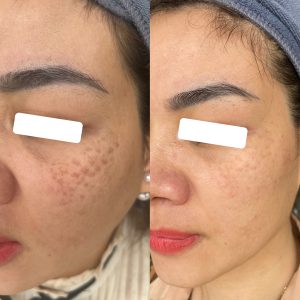 bớt hori là gì? mà lại bị nhầm với tàn nhang?- Hoa Hera Skincare