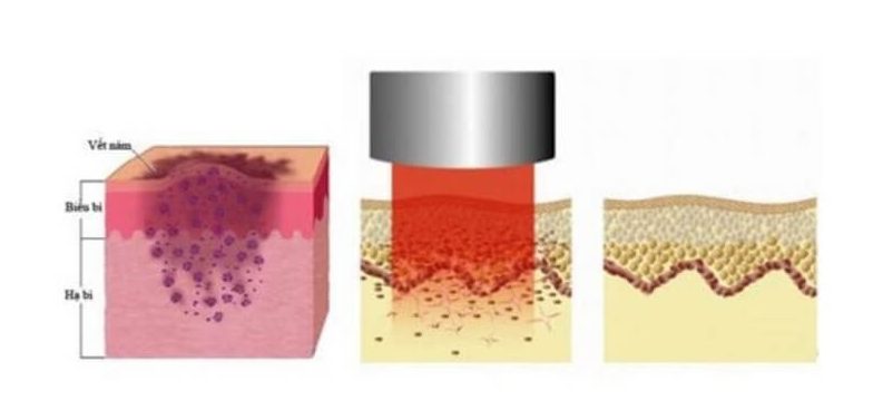 bắn laser với sắc tố bớt hori