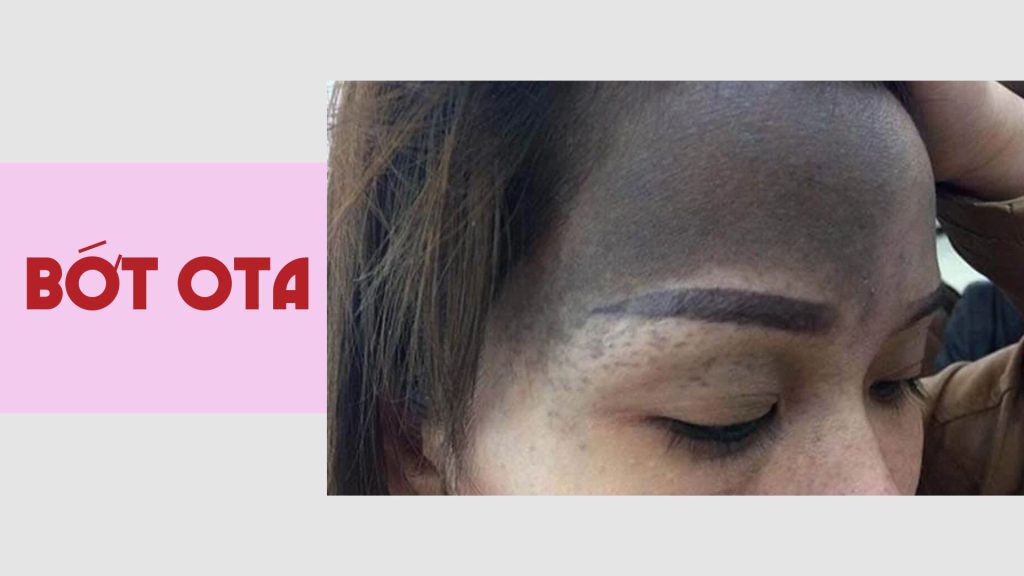 Bớt ota - hoa hera skincare