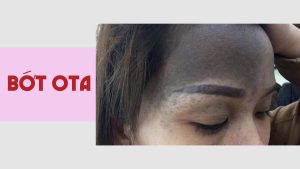 Bớt ota - hoa hera skincare