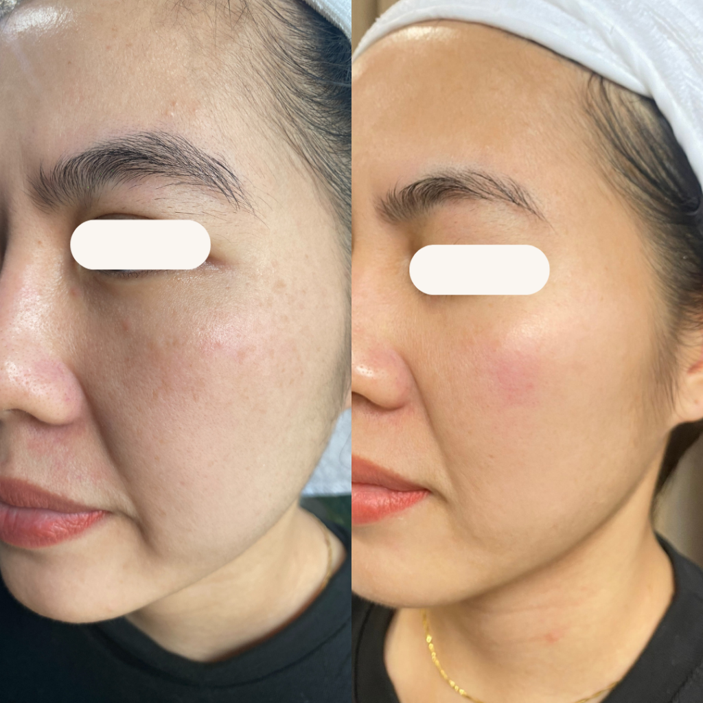 Nám má xuất hiện không chỉ vì mỗi tia UV mà còn cộng sự của nhiều yếu tố như: di chuyền, thay đổi nội tiết sau sinh