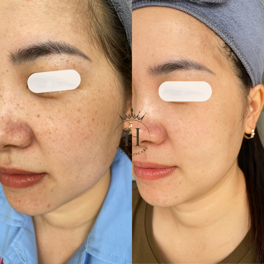 Tàn nhang có điều trị khó như điều trị nám không?
