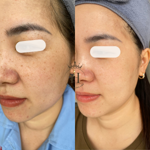 sắc tố da : tàn nhang