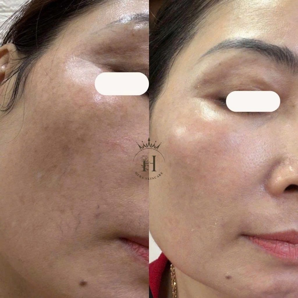 Sau thời gian dài dùng kem trộn corticoid thì da có dấu hiệu mỏng dần đi và lộ rõ mao mạch máu