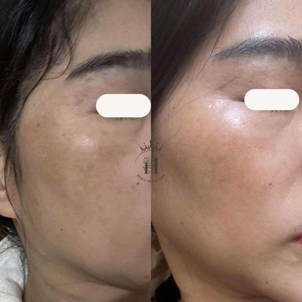Vì sao da dễ bị nám và dùng hoạt chất gì để hỗ trợ cải thiện nám