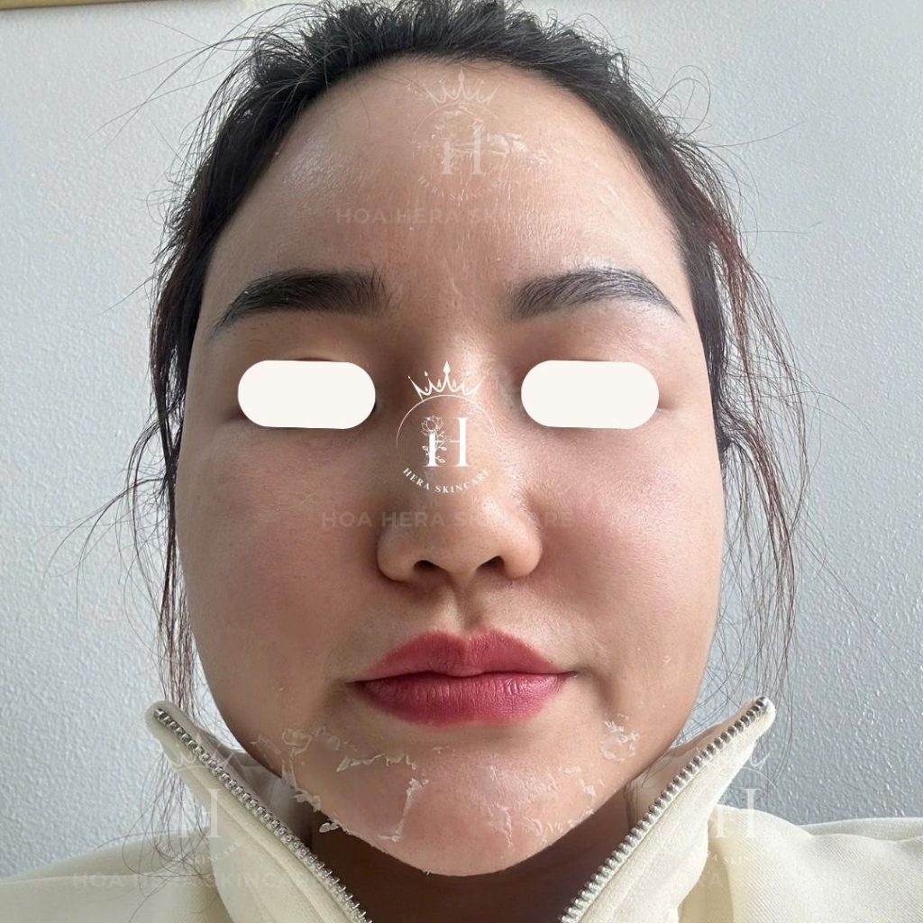 Cách hạn chế tăng sắc tố sau peel trên 1 nền da