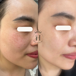 Phân biệt bớt hori như thế nào? Tại sao hori khó xử lý hơn nám thông thường?