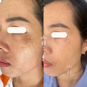Bớt hori không giống nám thông thường, vì sắc tố nằm ở lớp trung bì, nên khó xử lý hơn so với nám mảng thông thường