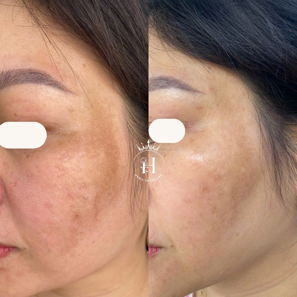 điều trị nám mảng mãi không hiểu quả là do đâu?