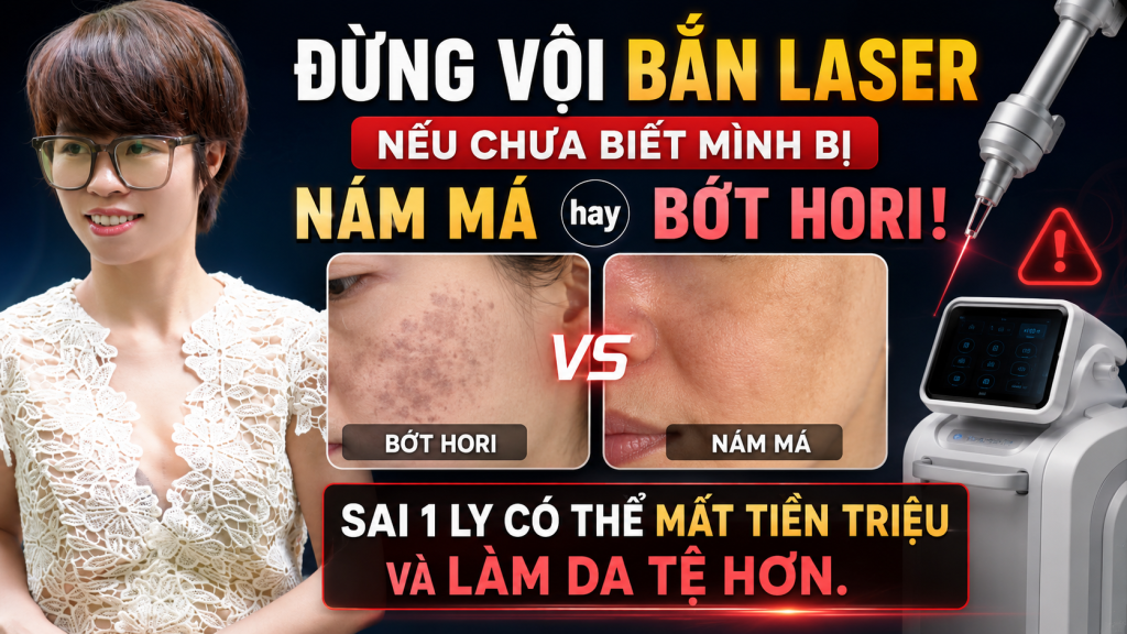 Đừng Vội Bắn Laser Nếu Chưa Biết Mình Bị Nám Má Hay Bớt Hori! Sai 1 đi tiền triệu