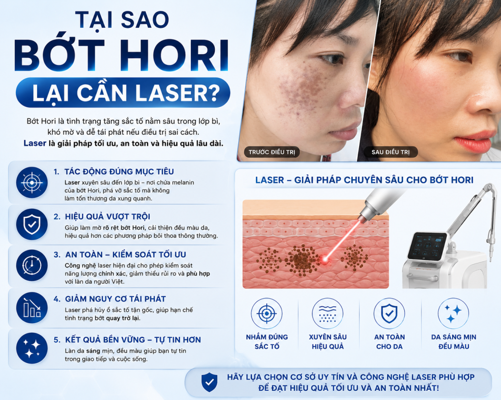Tại sao bớt hori lại cần laser để loại bỏ sắc tố