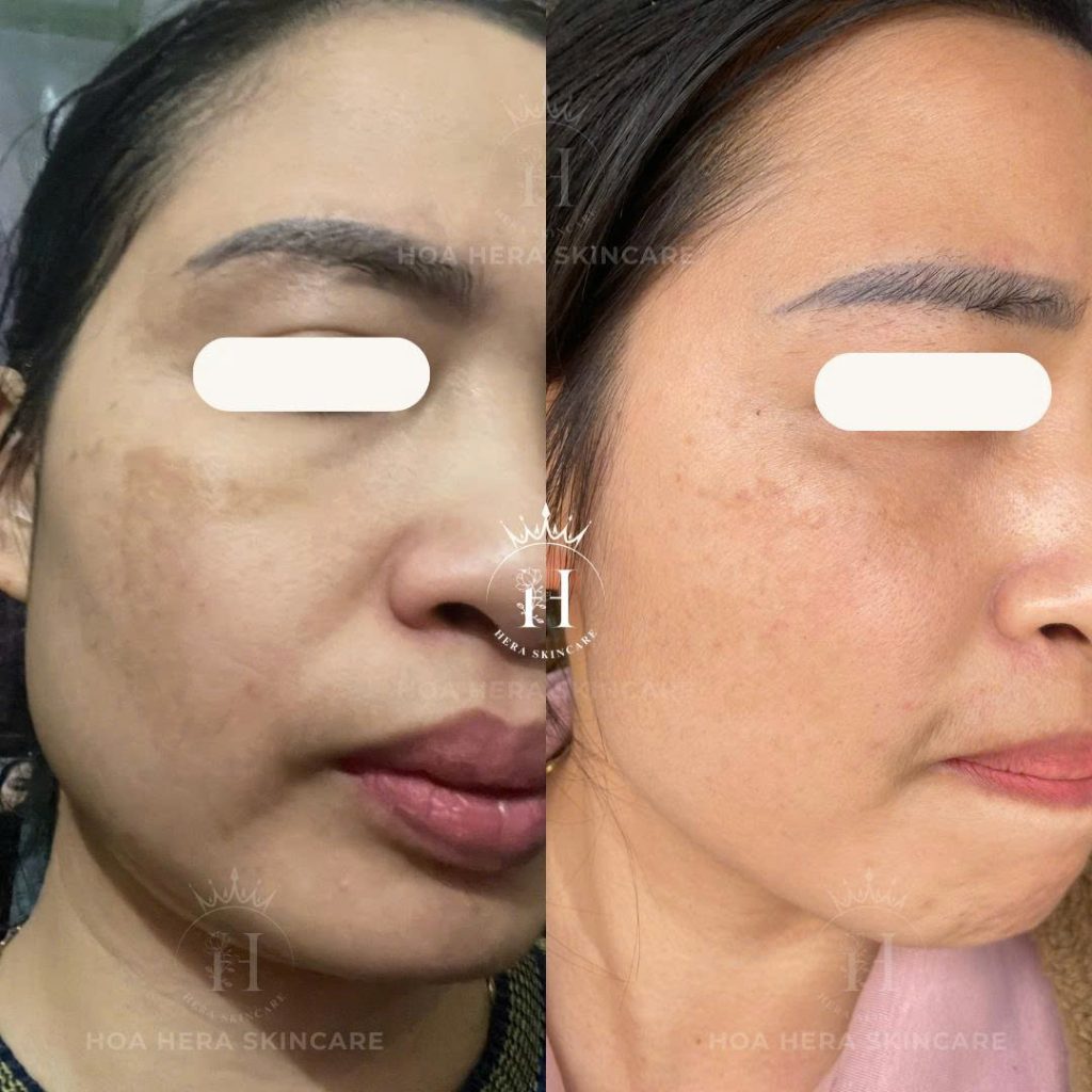 Nám da là gì? Điều trị nám có khó hay không?
