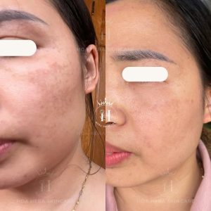 Nám má là sắc tố lớp bề mặt