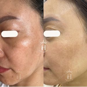 Nám má là 1 bệnh lý mãn tính, sẽ không bao giờ hết được hoàn toàn