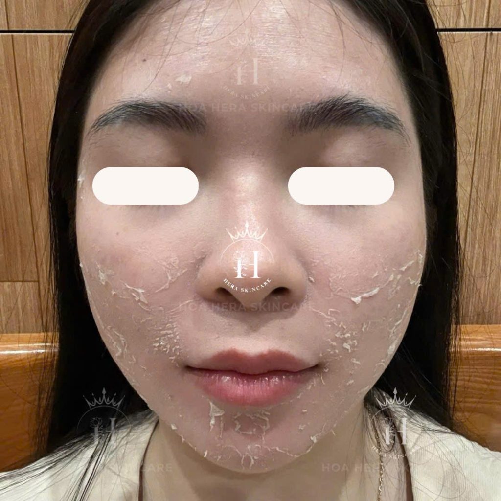 peel da hỗ trợ giảm thâm mụn, giảm xỉn màu