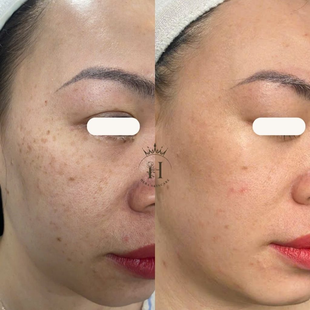 vì sao nam và tàn nhang ngày càng xuất hiện nhiều và khó điều trị nám hơn?