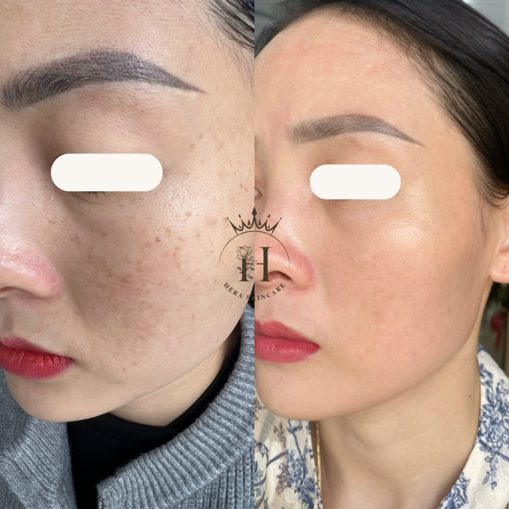 Tàn nhang mà xử lý sai cách thì gây ra hậu quả gì?