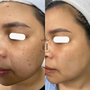 tàn nhang ở má phụ nữ sau sinh
