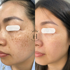 tàn nhang ở má bẩm sinh từ bé