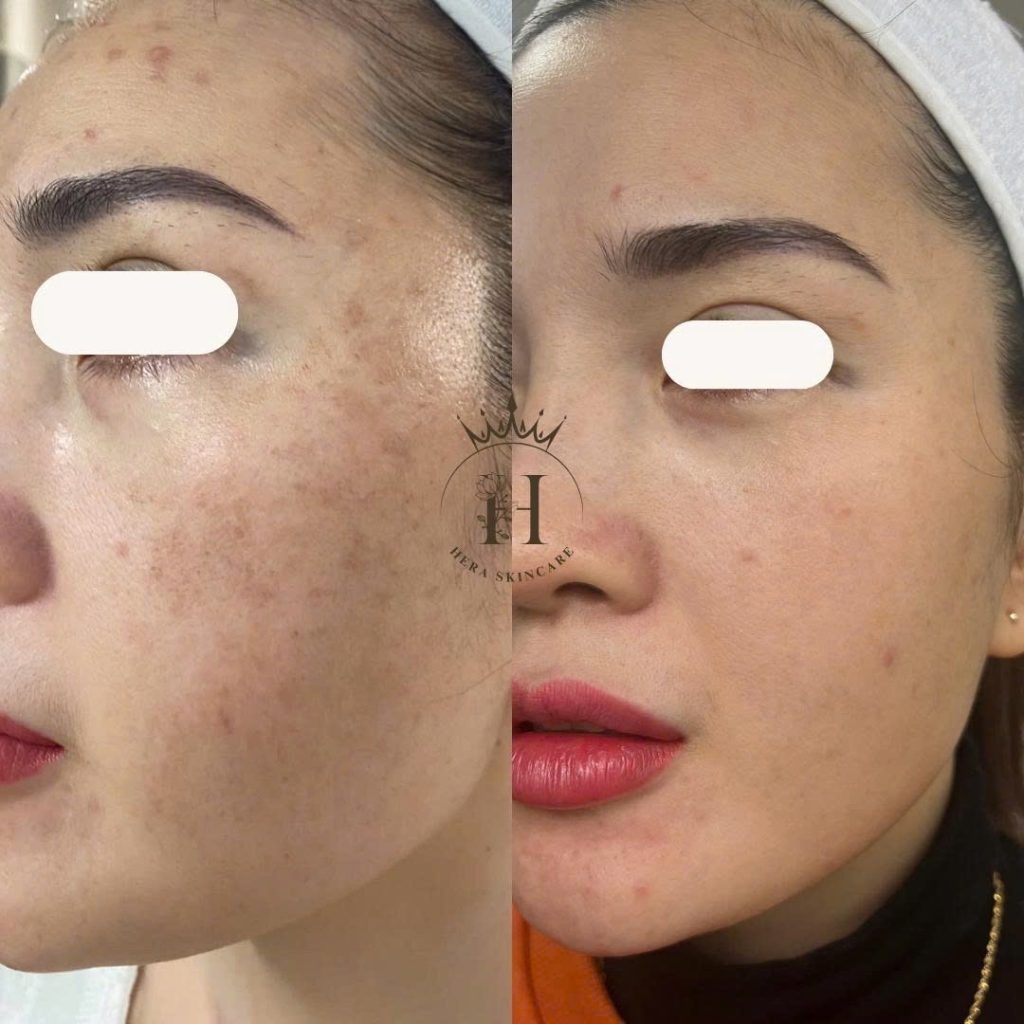 Tăng Sắc Tố Sau Viêm 