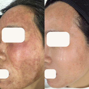 Vì sao peel da sai cách lại gây ra hậu quá khó lường?