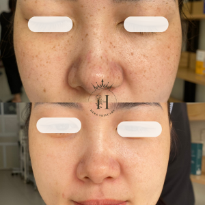tàn nhang sau sinh có xử lý hết được không?