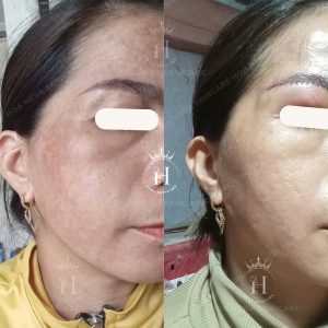 phục hồi nền da dính kem trộn 