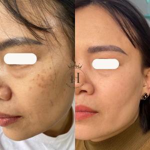 vết loang hori trên mặt tại sao bôi lại không thể hết