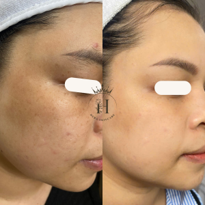 vì sao lại xuất hiện sắc tố tàn nhang?