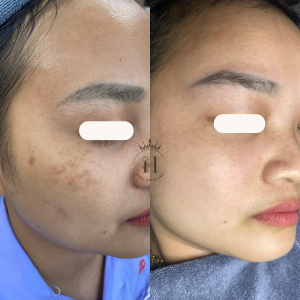 nám chân đinh có xử lý được hết không?