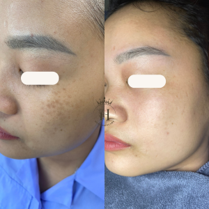 Nhiều người hay nhầm nám chân đinh với nám thường