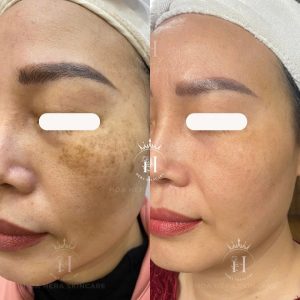 nám hỗn hợp khó xử lý hơn nhiều so với các loại sắc tố đứng 1 mình