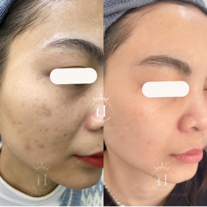 Xử lý nám chân đinh đơn giản bằng laser