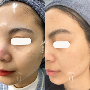 xử lý như thế nào là an toàn với nám chân đinh