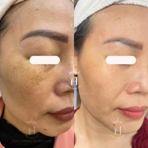xử lý nám hỗn hợp như thế nào?