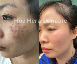 nám chân đinh chọn phương pháp laser là đúng nhưng tại sao càng laser nám chân đinh lại càng vỡ loang chân và mất sắc tố