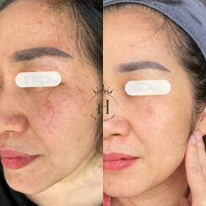 nhận diện được đốm nâu trên mặt rồi thì xử lý như thế nào?