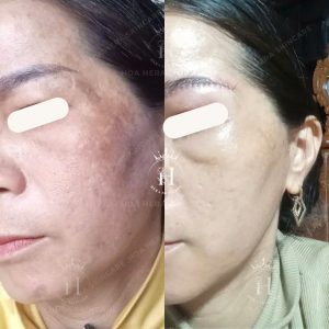 phục hồi lại nền da đã từng sử dụng qua kem trộn