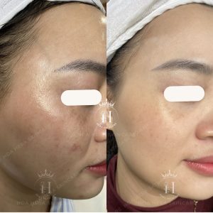 1 ngày bôi 10 ngày nghỉ thì xử lý nám như thế nào mới hiệu quả?