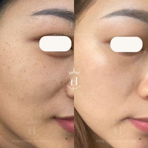 chấm TCA cần lưu ý