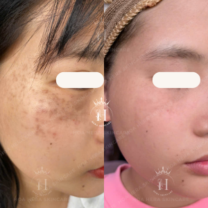vết loang hori trên mặt
