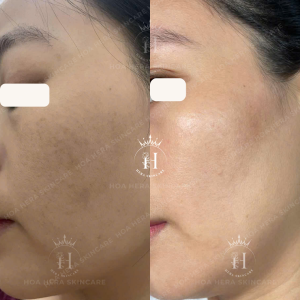 xử lý nám như thế nào để hạn chế nám tại phát?