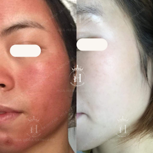 Nám do mỹ phẩm chỉ giảm đi, chứ không thể hết hoàn toàn
