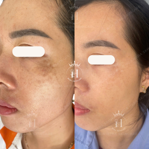 xử lý vết loang hori trên mặt dễ hơn bạn tưởng