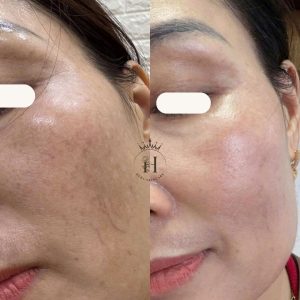 Phục hồi da trước, xử lý tăng sắc tố sau