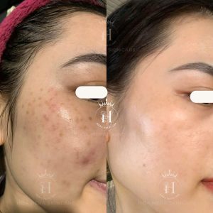vì sao xử lý tàn nhang mãi không hết?