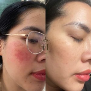 da đỏ lại cứ bôi thêm treatment là đỡ lầm tưởng về chăm sóc da của nhiều chị em 