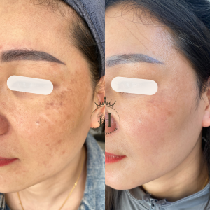 nám hỗn hợp xử lý khó hay dễ?